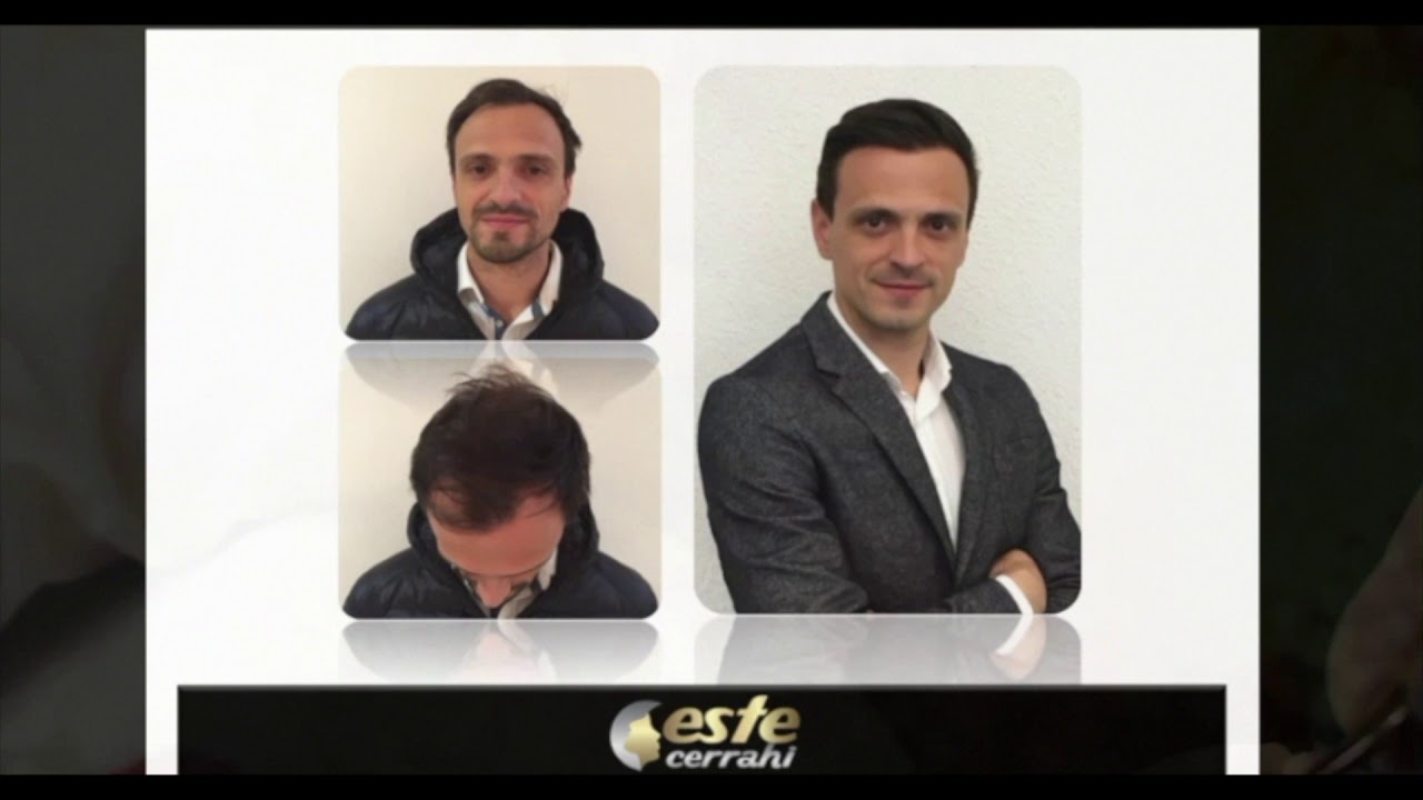 este surgery hair transplant cli