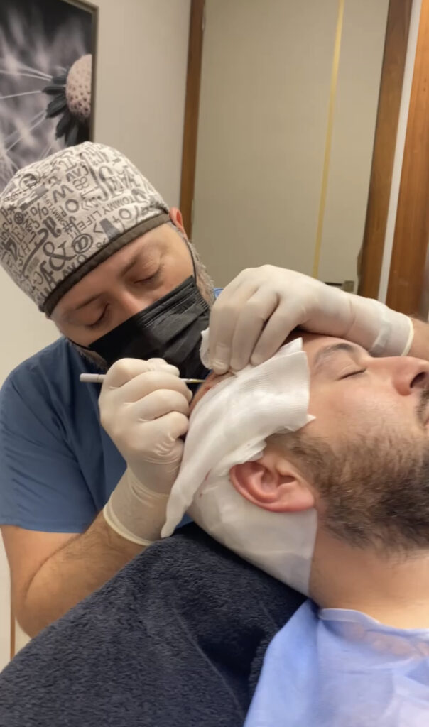 este surgery hair transplant surgery 10