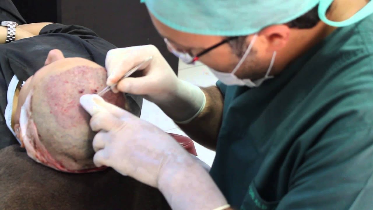 hair transplant for women dr alp