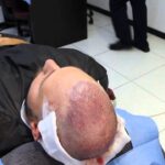 hair transplant in turkey dr alp Previous Post Image