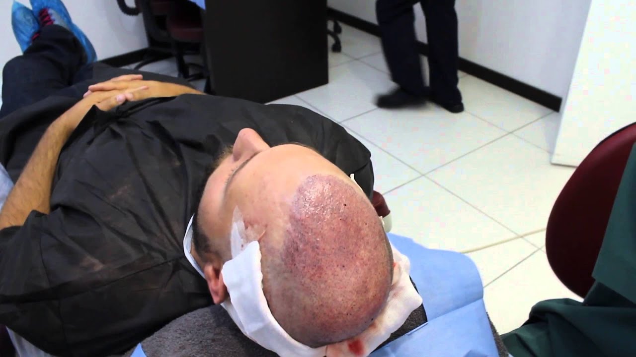 hair transplant in turkey dr alp