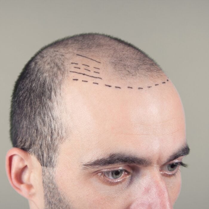 how we decide the natural hair line