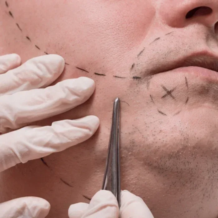 beard transplant price guide key factors affecting the cost