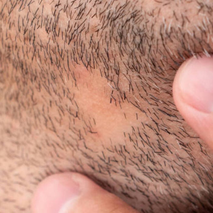 beard transplant recovery timeline and essential care instructions