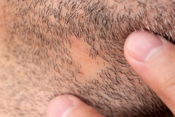 beard transplant recovery timeline and essential care instructions