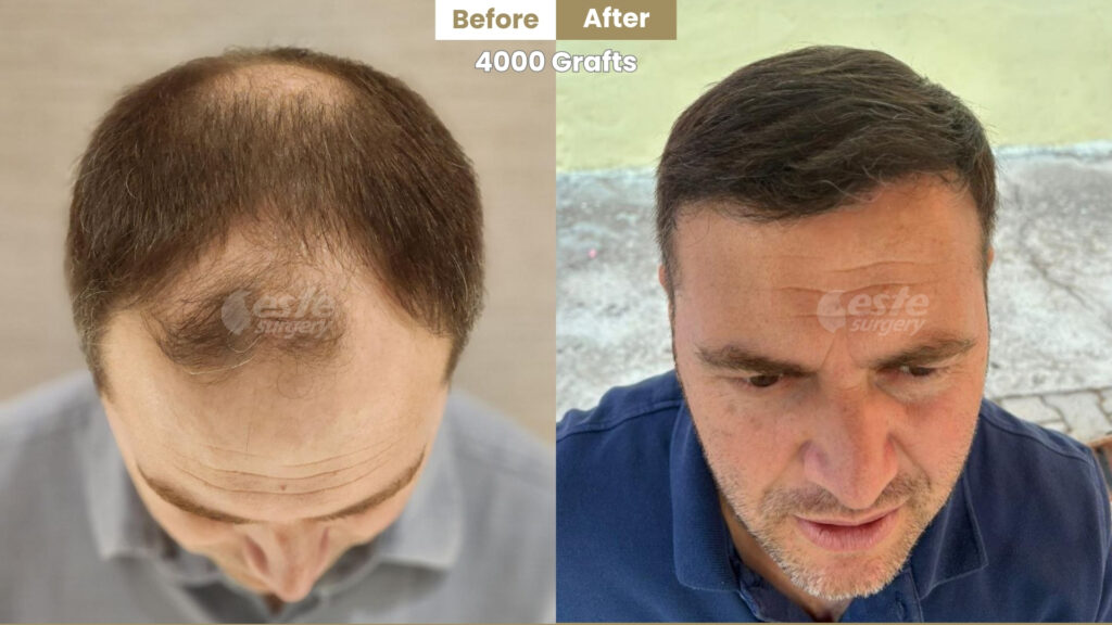 este surgery before after 1