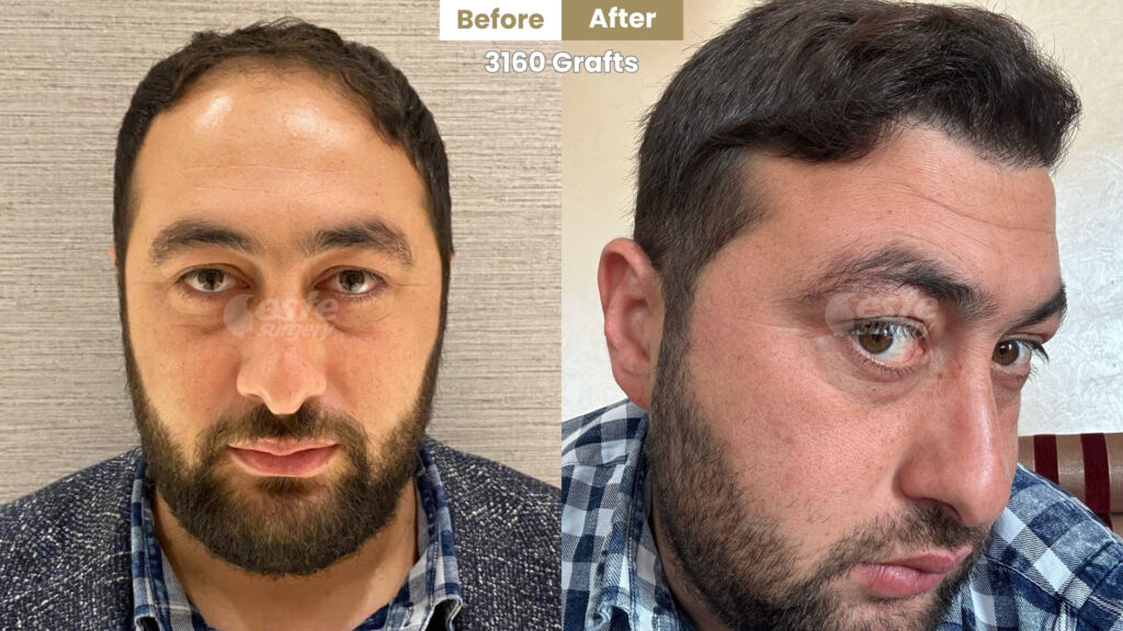 este surgery before after 10 Frontal Area Hair Transplant before and after