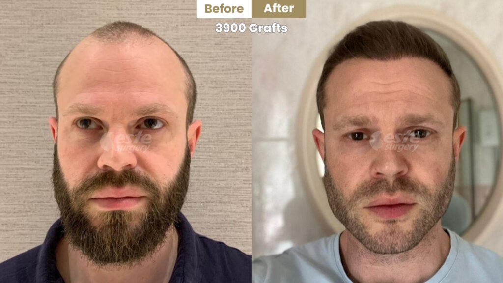 este surgery before after 11 Personalised Hair Transplant in Turkey