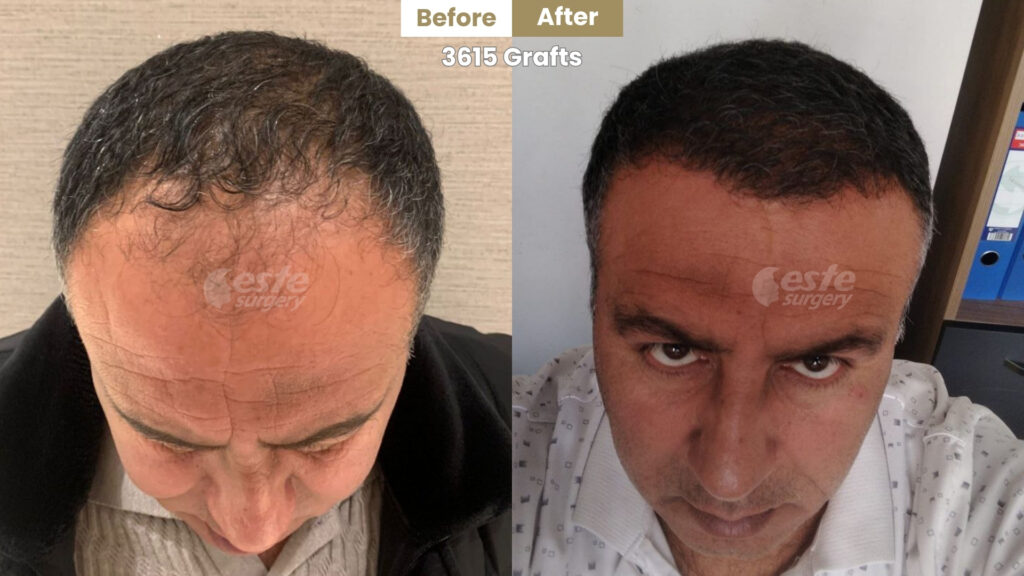 este surgery before after 12