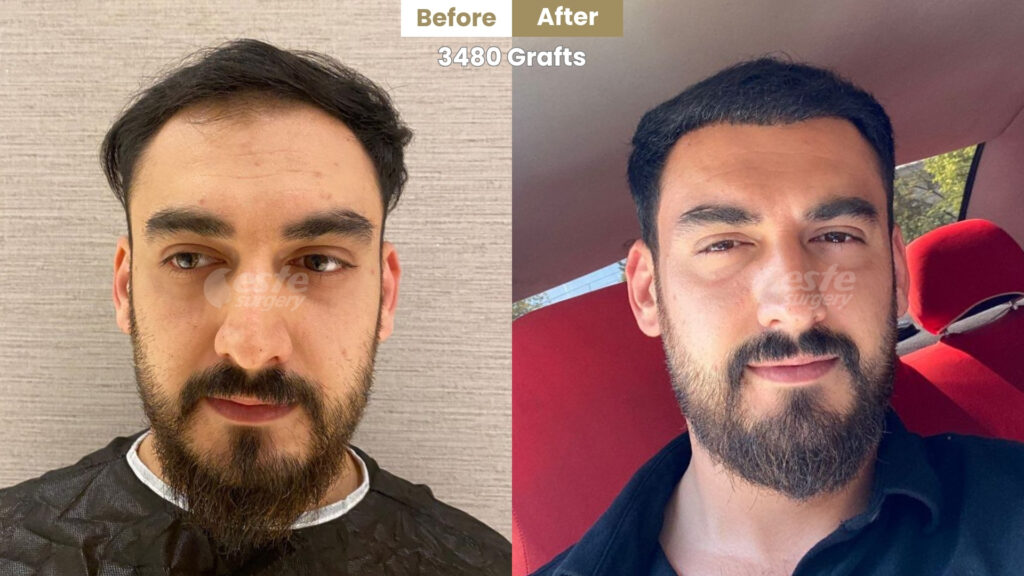 este surgery before after 13 3500 Grafts Hair Transplant Before and After