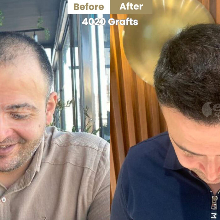 este surgery before after 14 este surgery before after 14