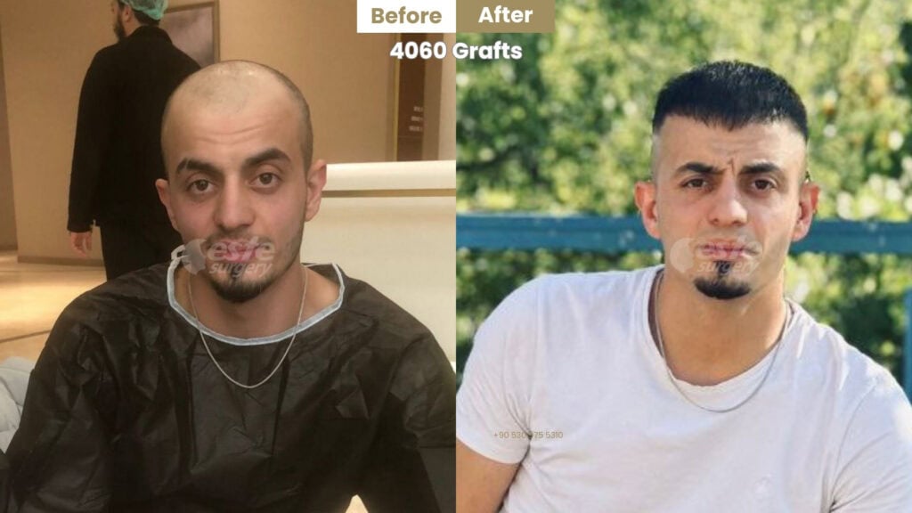 este surgery before after 15