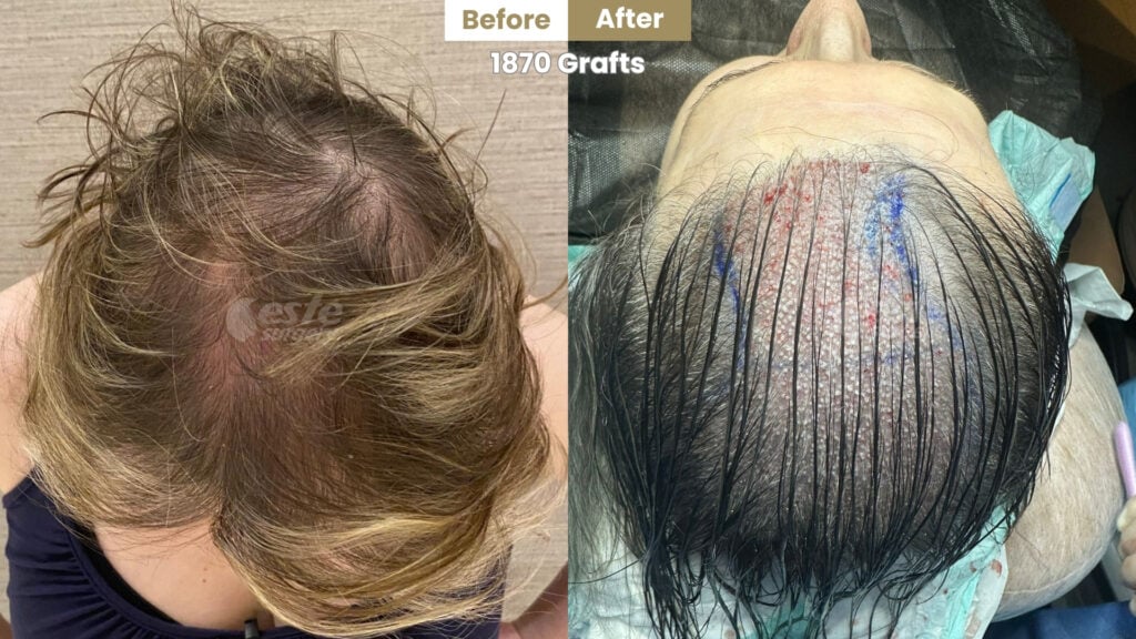 este surgery before after 16