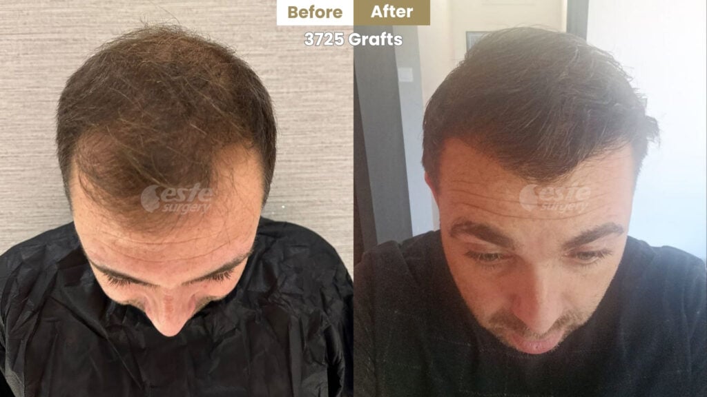 este surgery before after 17