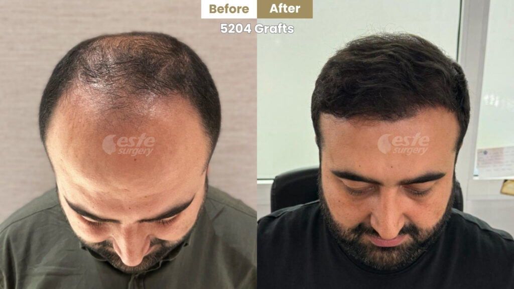 Result of DHI Hair Transplant in Turkey