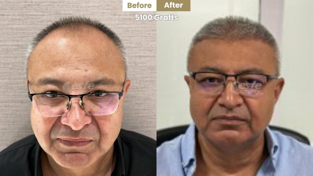 este surgery before after 20 before and after hair transplant in turkey 7 months