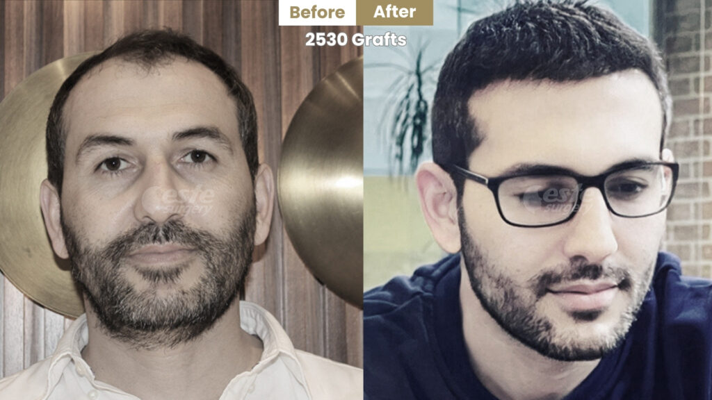 este surgery before after 21 norwood scale 4 before and after hair transplant