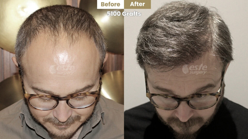 este surgery before after 22 FUE Hair Transplant Turkey Before and After