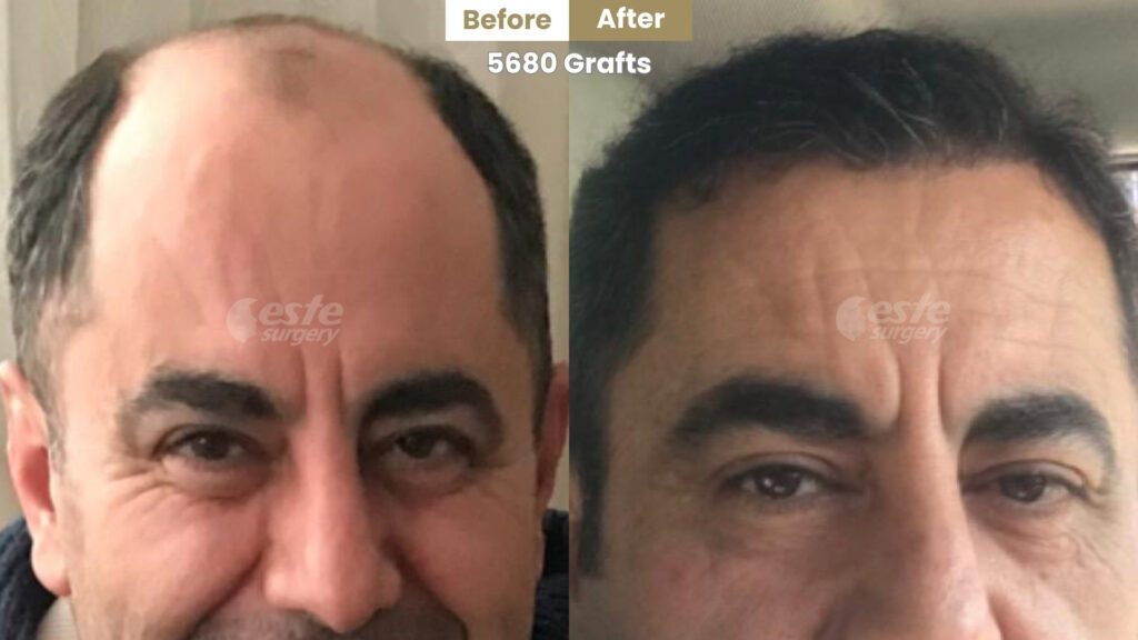 este surgery before after 23