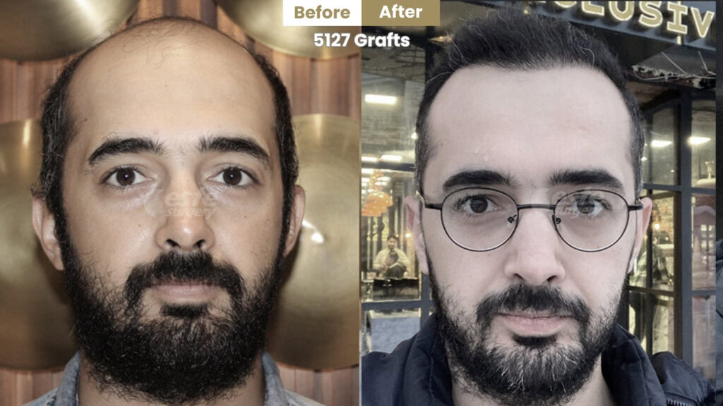 este surgery before after 24 Before and After Sapphire FUE Hair Transplant in Turkey