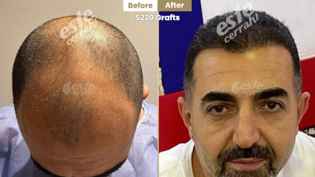 este surgery before after 25 Best Hair Transplant Result in Turkey
