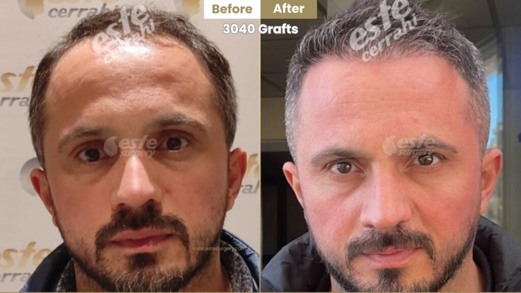 a very good sample of a natural hairline design from Dr Alp ASLAN