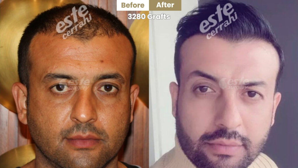este surgery before after 27 Istanbul Hair Transplant Result