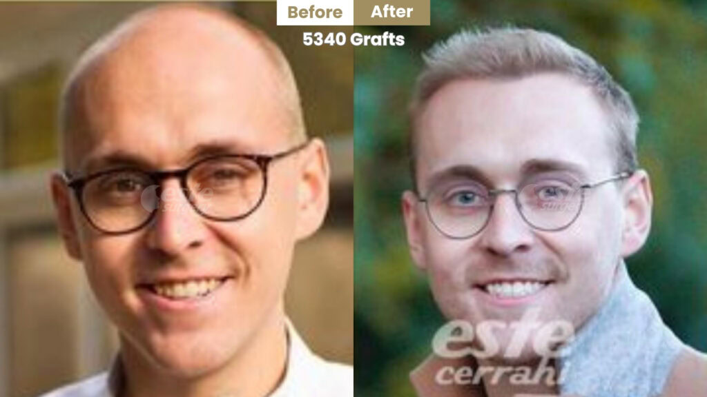 well balanced and natural looking hairline