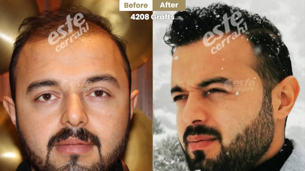 este surgery before after 29 Result of 4200 Grafts Hair Transplant by Dr Alp Aslan