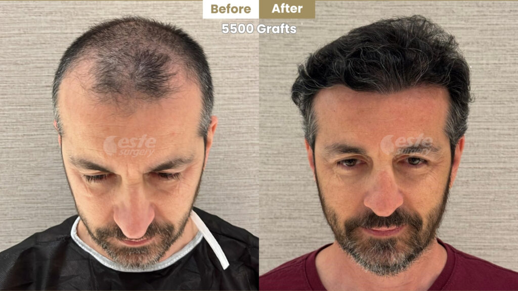 Before and After DHI Hair Transplant