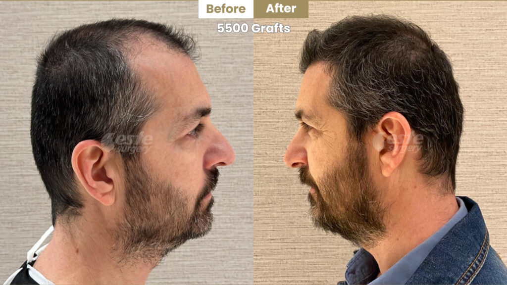 este surgery before after 4 Hair Transplant Turkey Result