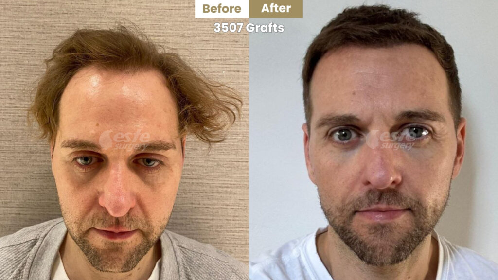 este surgery before after 5