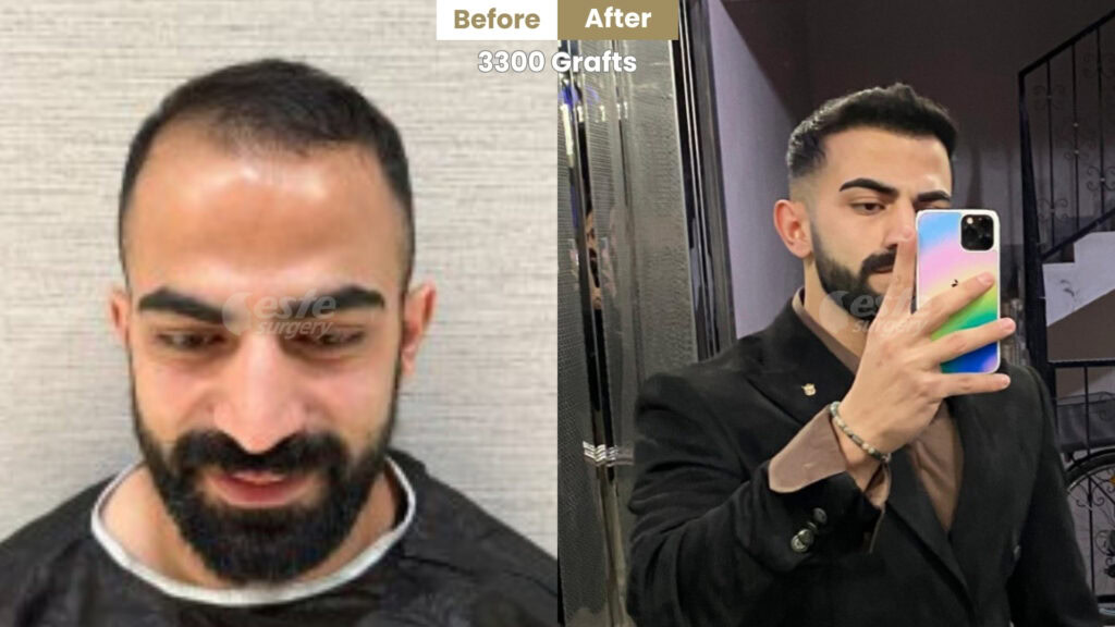 este surgery before after 6 Before and After hair transplant at Este Surgery