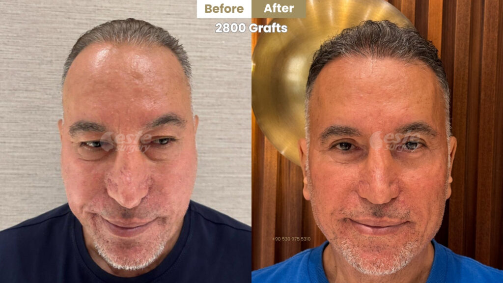 este surgery before after 7 Before and After Hair Transplant in Turkey