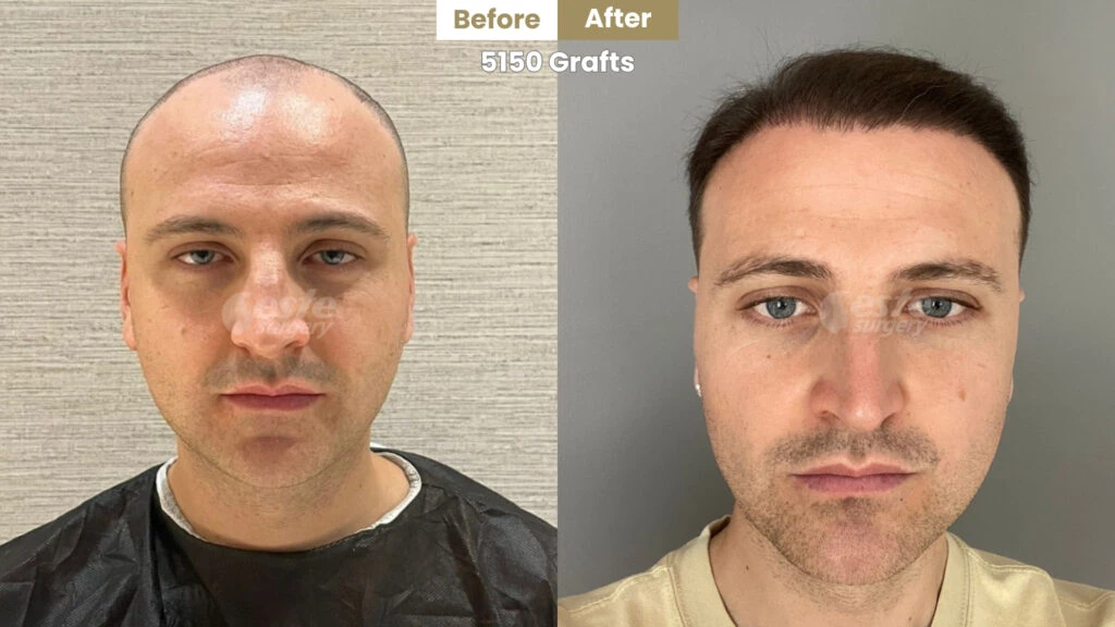 este surgery before after 8 8 months result of hair transplant in Turkey