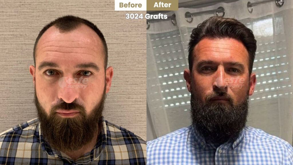 este surgery before after 9