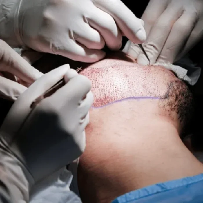 the beard transplant procedure a step by step informational overview
