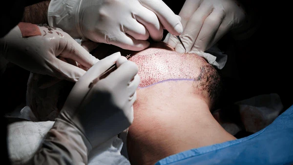 the beard transplant procedure a step by step informational overview