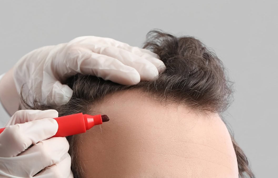 Sapphire DHI Hair Transplant
