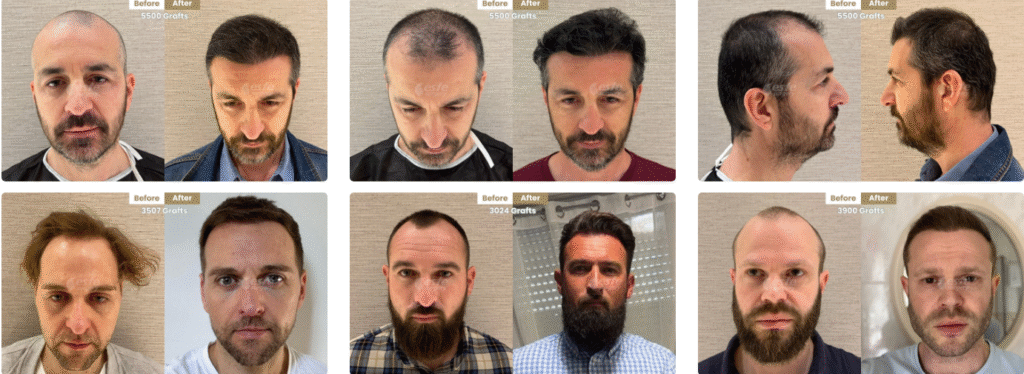 Why Choose Este Surgery for Hair Transplant in Turkey