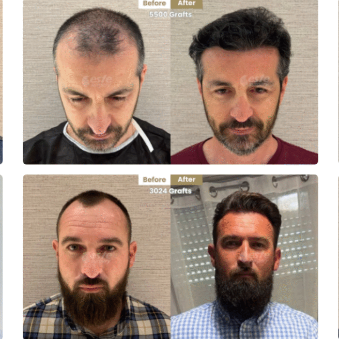 Why Choose Este Surgery for Hair Transplant in Turkey?