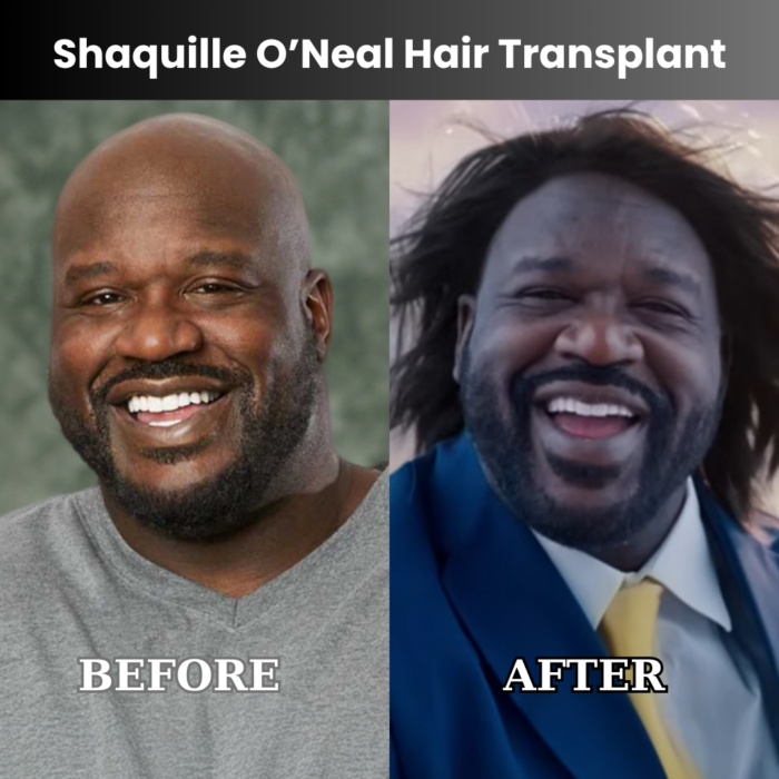 Shaquille O’Neal Hair Transplant Before and After