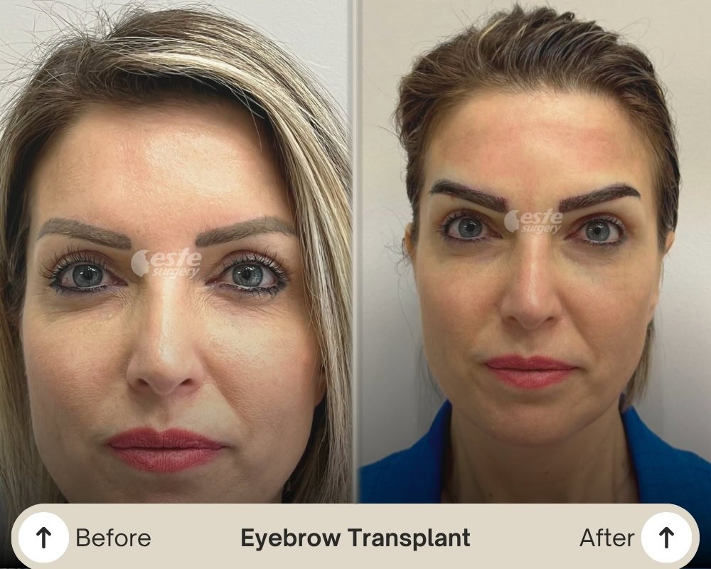 before and after eyebrow transplant before and after eyebrow transplant