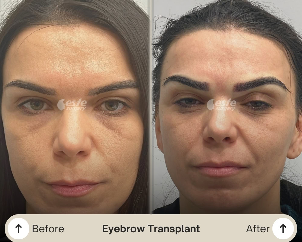 brow transplant este surgery brow transplant este surgery