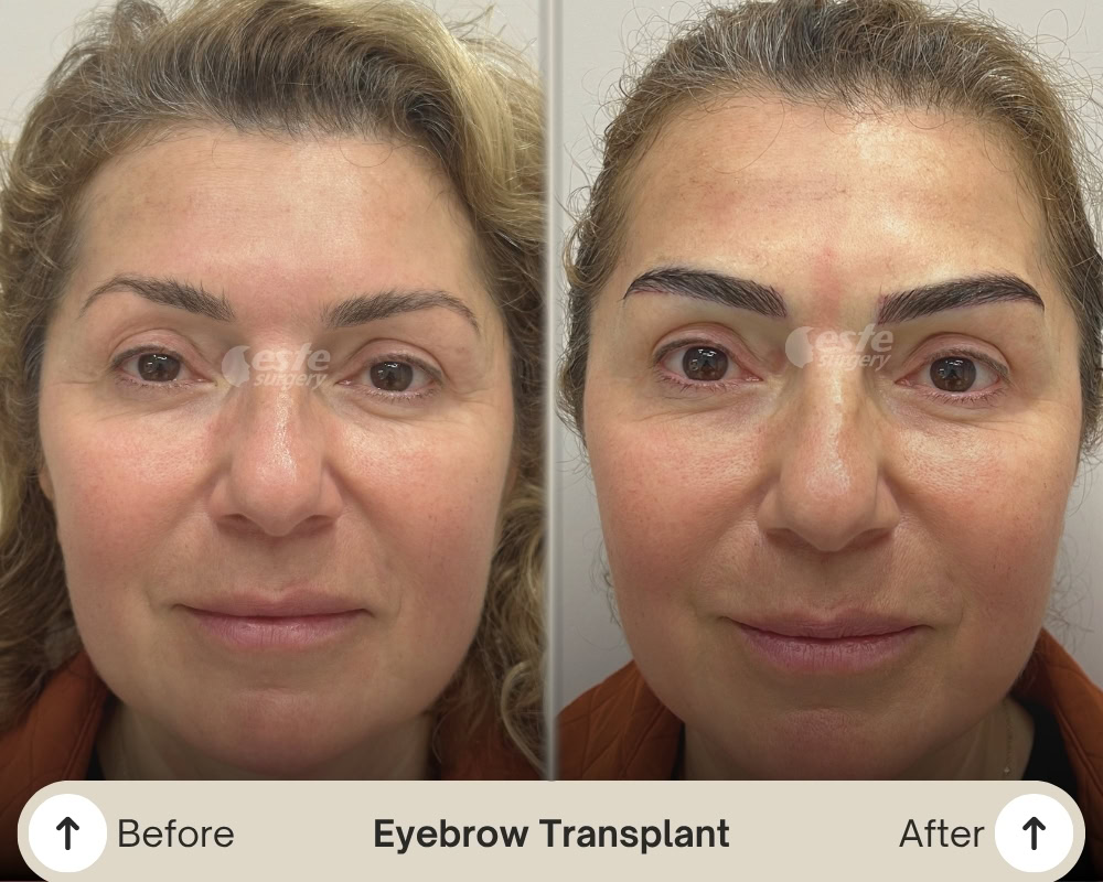 brow transplant turkey brow transplant turkey