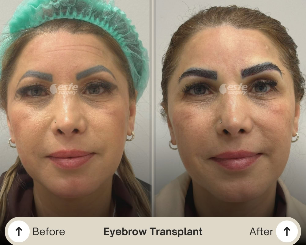 este surgery eyebrow t ransplant result este surgery eyebrow transplant result