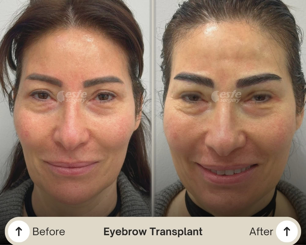 eyebrow restoration before and after eyebrow restoration before and after