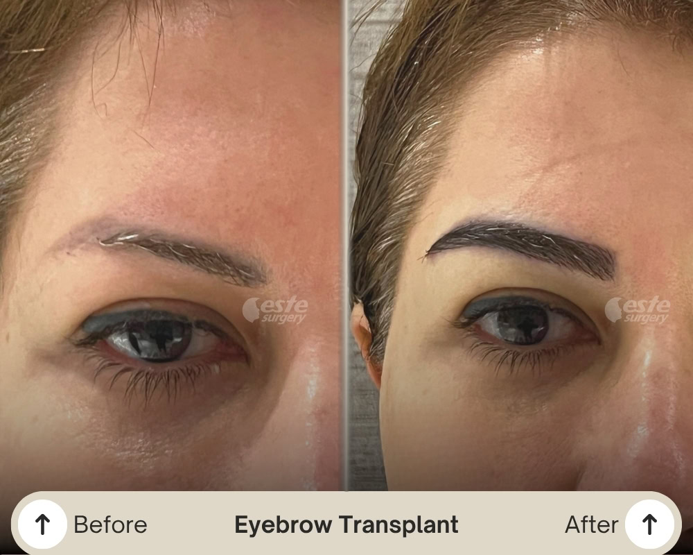 eyebrow transplant before after eyebrow transplant before after