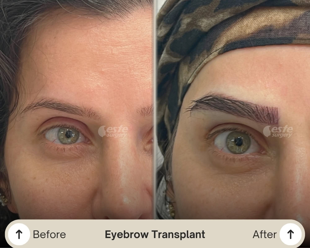 eyebrow transplant result turkey eyebrow transplant result turkey