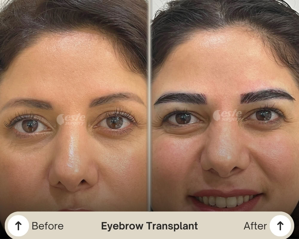 eyebrow transplant result eyebrow transplant result
